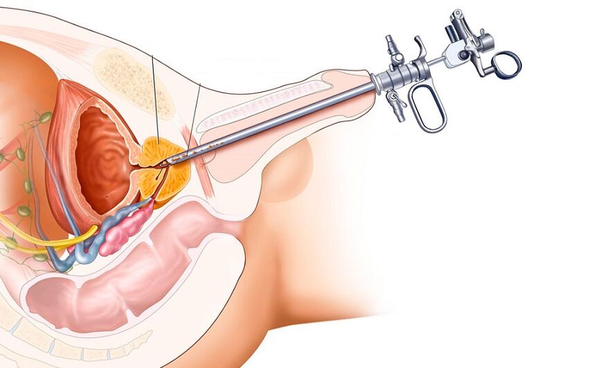 Chirurgische Behandlung von Prostatitis