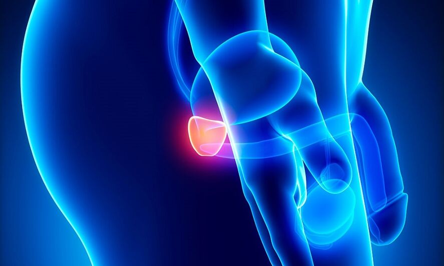 Entzündung der Prostata mit Prostatitis